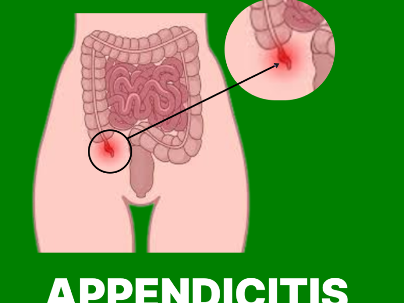 Appendicitis: Causes, Symptoms, Types and Treatment