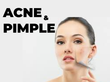 Acne and Pimple