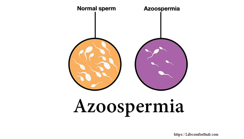 Azoospermia