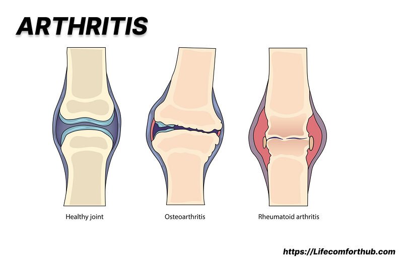 Arthritis