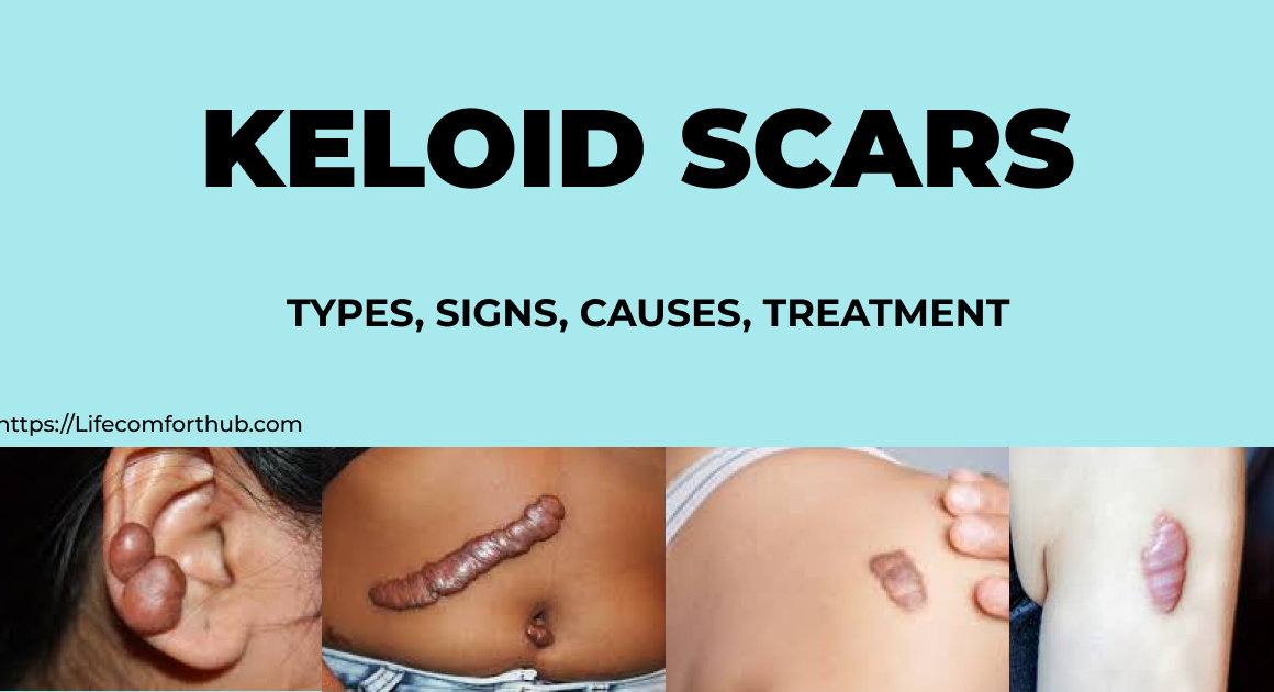 keloids