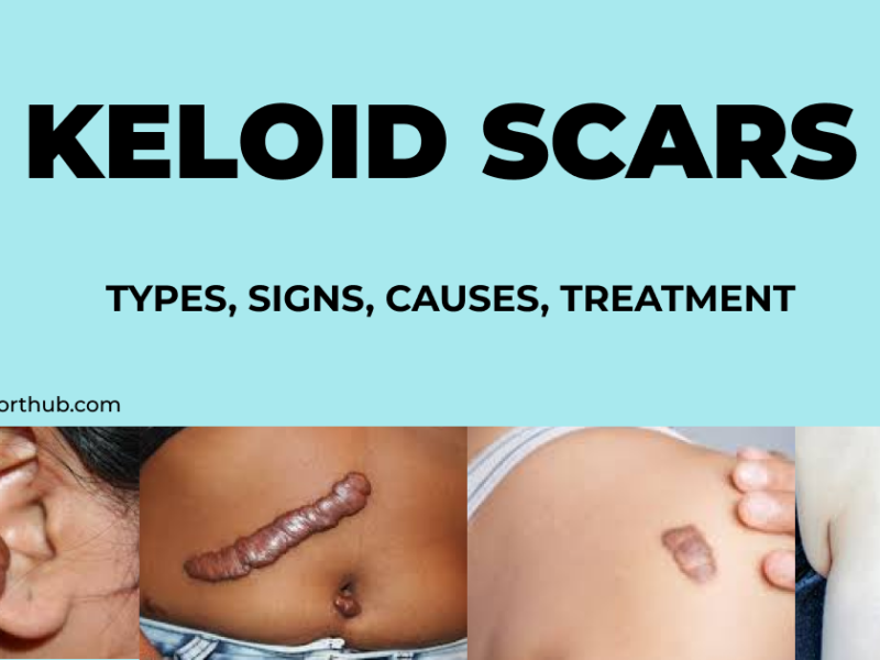 keloids